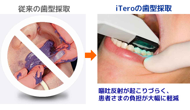 歯型採取の負担が大幅に軽減