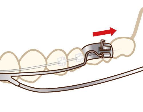 歯に圧力を加え続けることで少しずつ歯が動いていきます